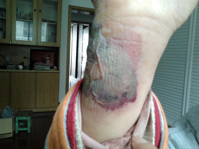 ＿左上肺纖維化