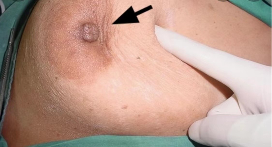 乳腺癌乳頭內陷圖 