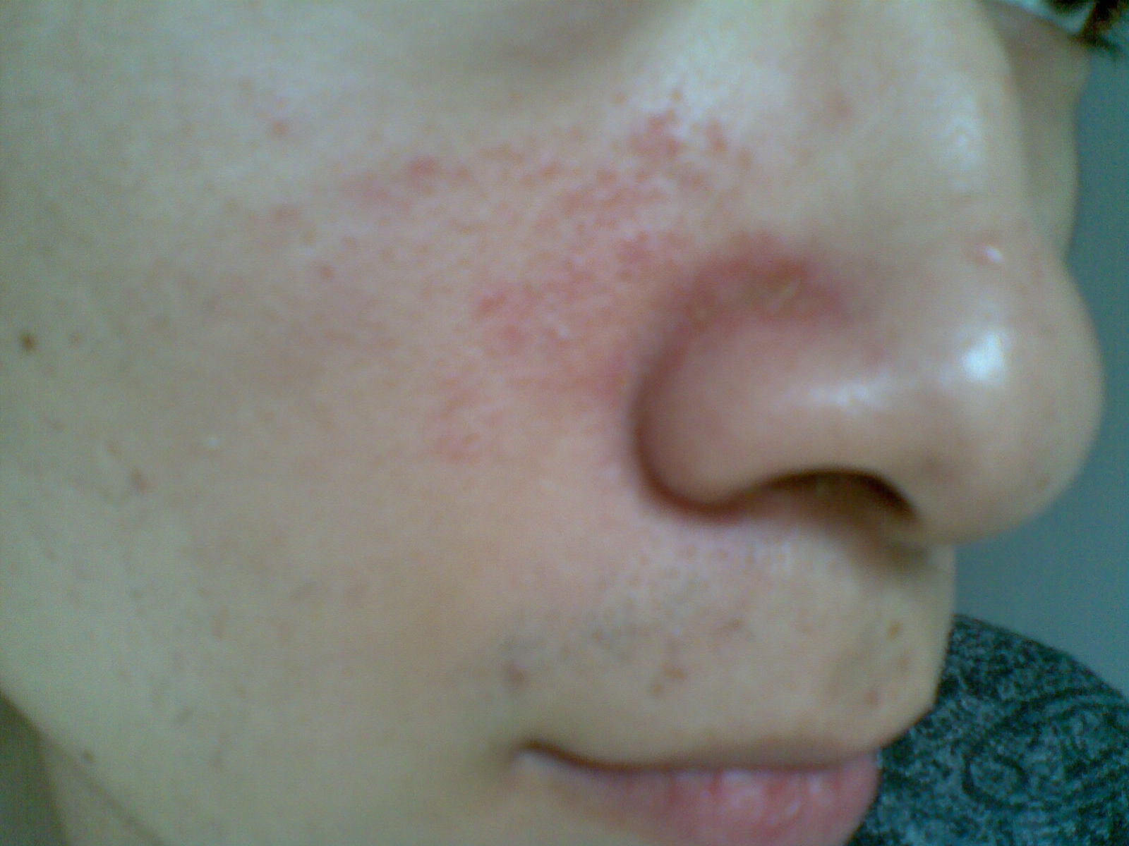 面部日光性皮炎