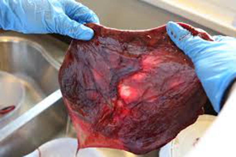 人胎盤形狀顏色