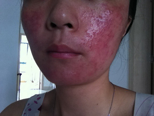 神經性皮炎的治療 (9) 