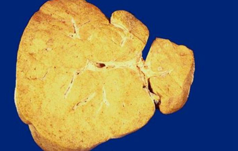  重度酒精肝的併發症的