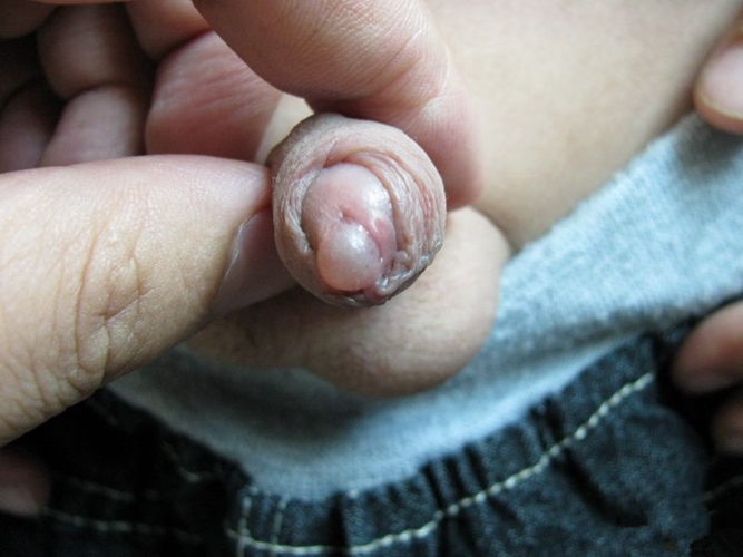 陰莖中線囊腫尿路感染