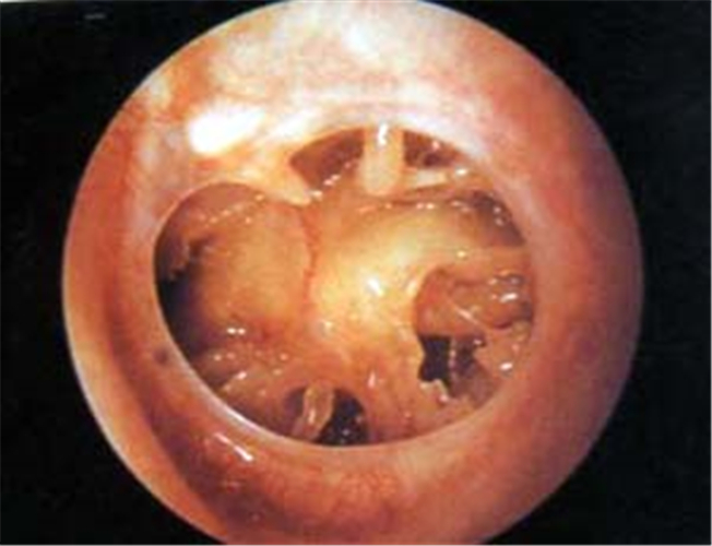 炎症導致鼓膜穿孔