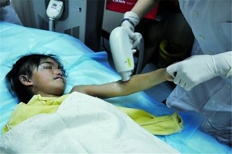 先天性多毛症治療