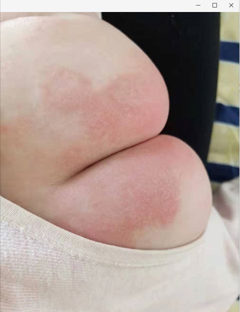 寶寶紅屁屁照片 (46) 