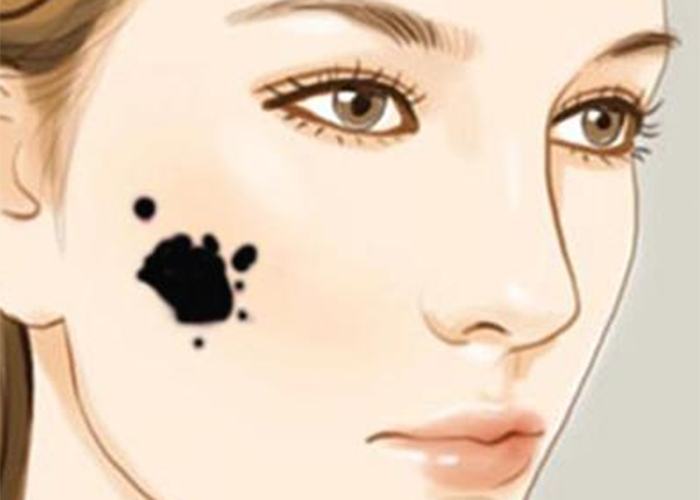 女人鮮紅斑痣的常見症狀 