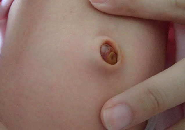 寶寶臍帶脫落後