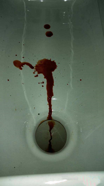 腸癌的症狀 (41) 