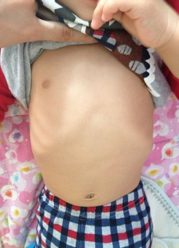 寶寶缺鈣雞胸圖 (7) 