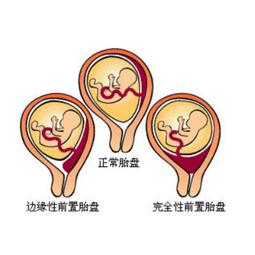 胎盤早剝對比圖 