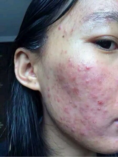 激素臉排毒症狀 (54) 