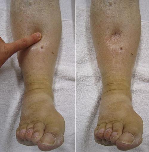 糖尿病腎病水腫嚴重