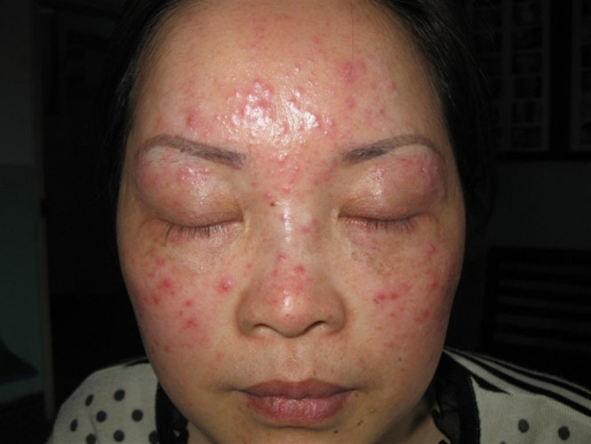 粟粒性皮膚結核病