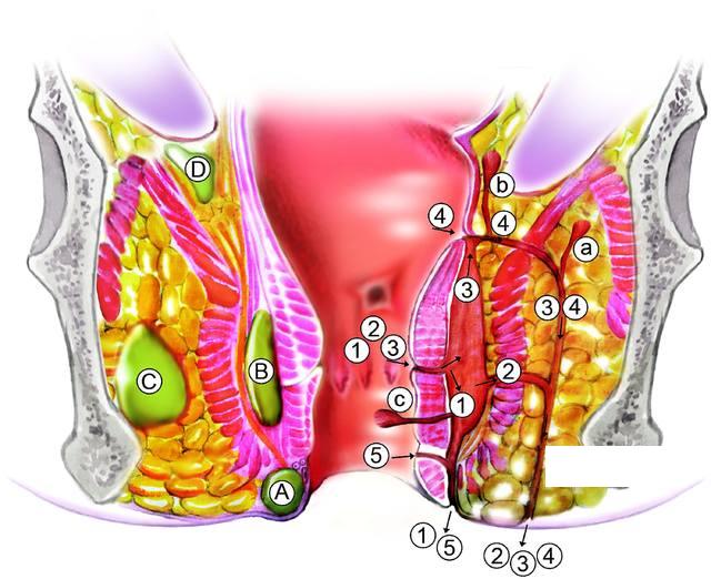 克羅恩病是原因不明的腸道炎症性疾病 
