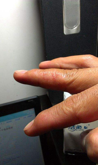 手指溼疹症狀