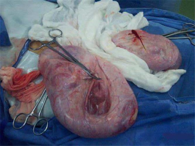 手術中的卵巢囊腫