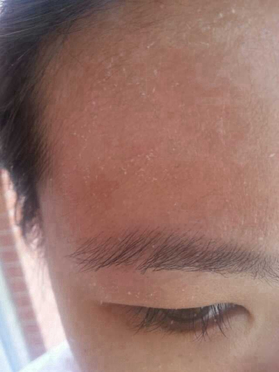 急性皮炎的症狀