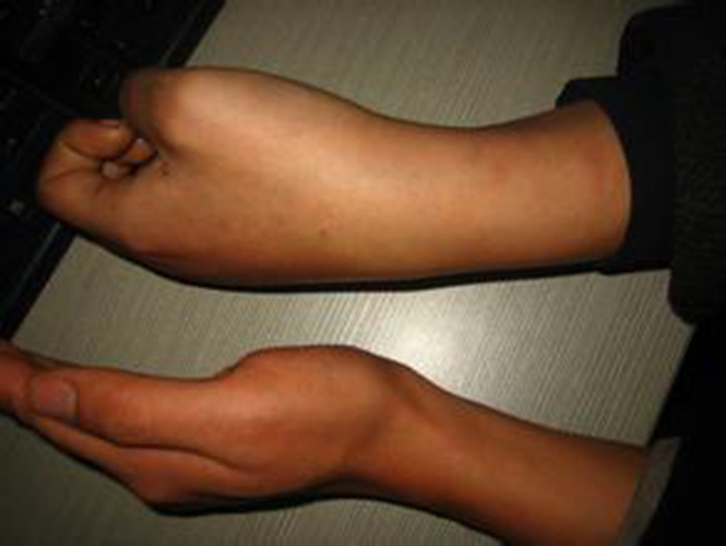 糖尿病腎病手部的對比