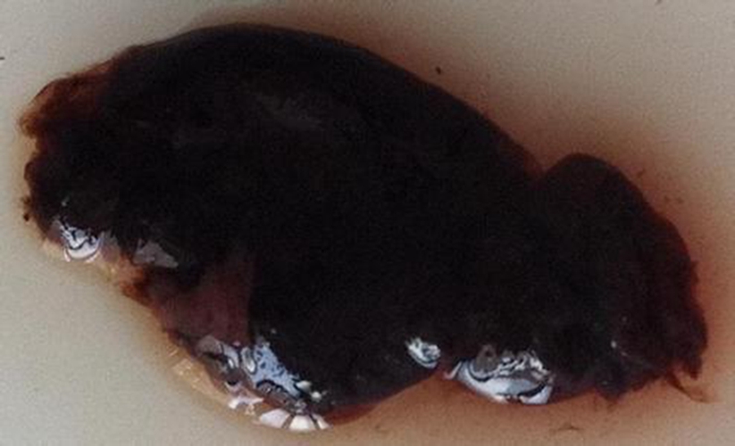 藥物流產的排出孕囊的