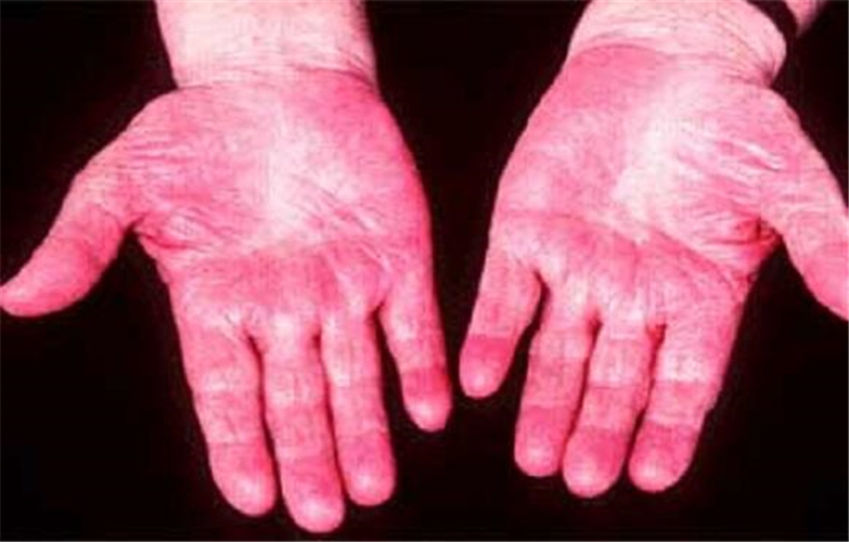 酒精肝手部症狀