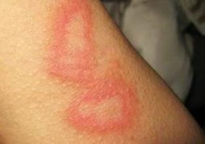 同位素放射性皮炎