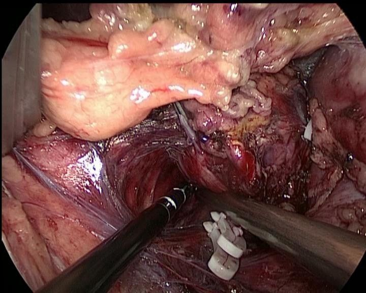 左側腎上腺腫瘤手術