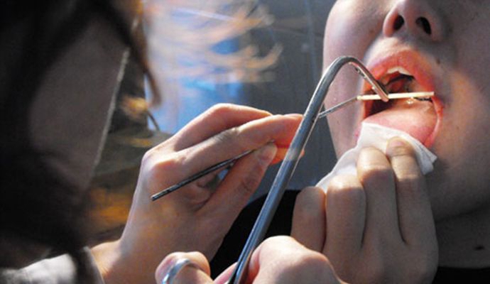 咽喉癌的早期症狀