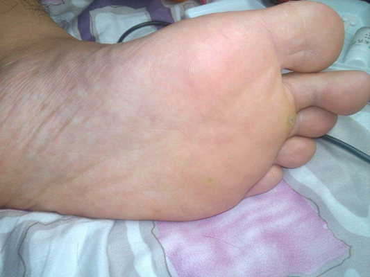 腳底蹠疣早期