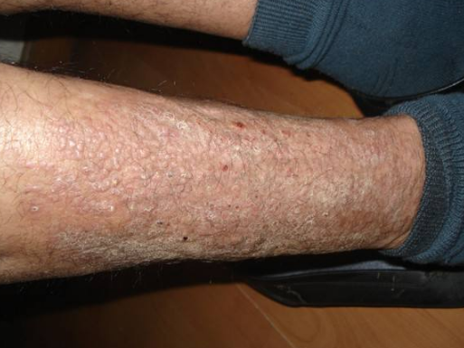 皮膚澱粉樣變 (53) 