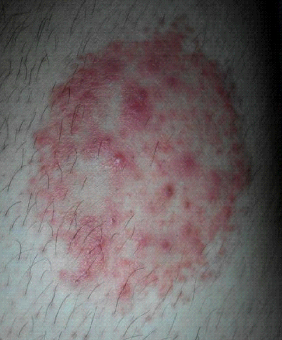 艾滋病前期皮囊炎 