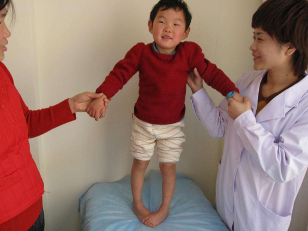 痙攣型腦癱 (50) 