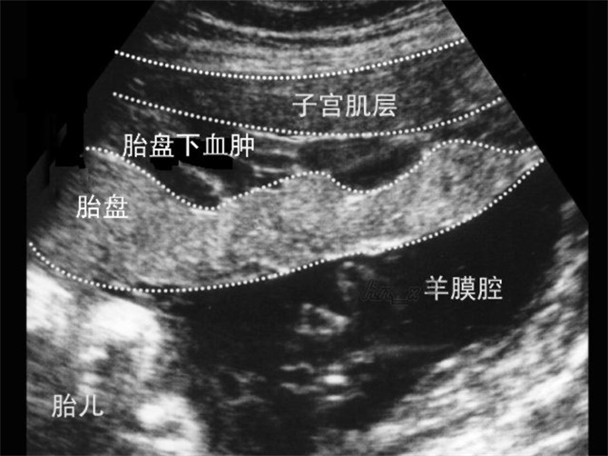 胎盤早剝胎盤血腫