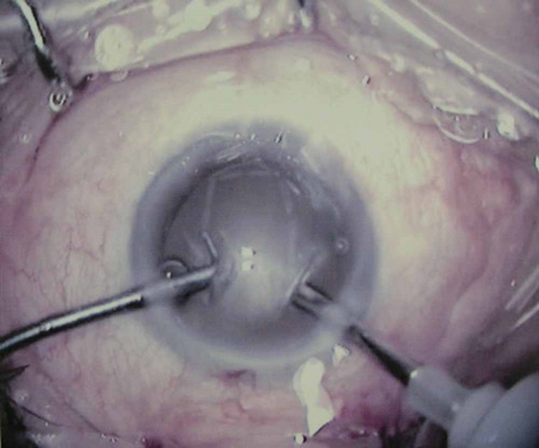 先天青光眼症狀的