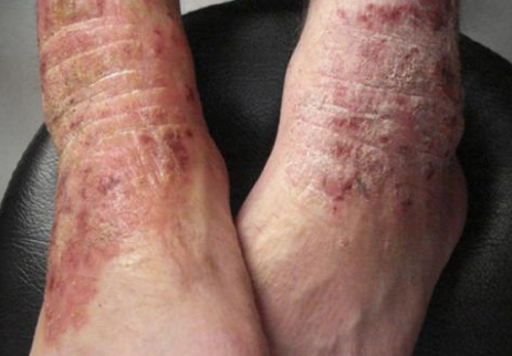 皮膚澱粉樣變 (52) 