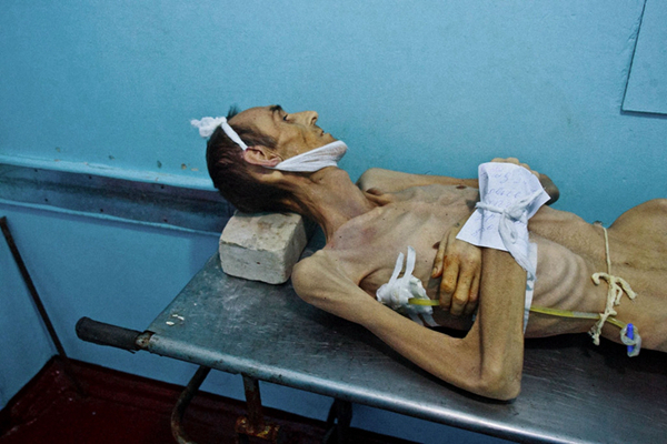 空洞型肺結核能活多久 (46) 