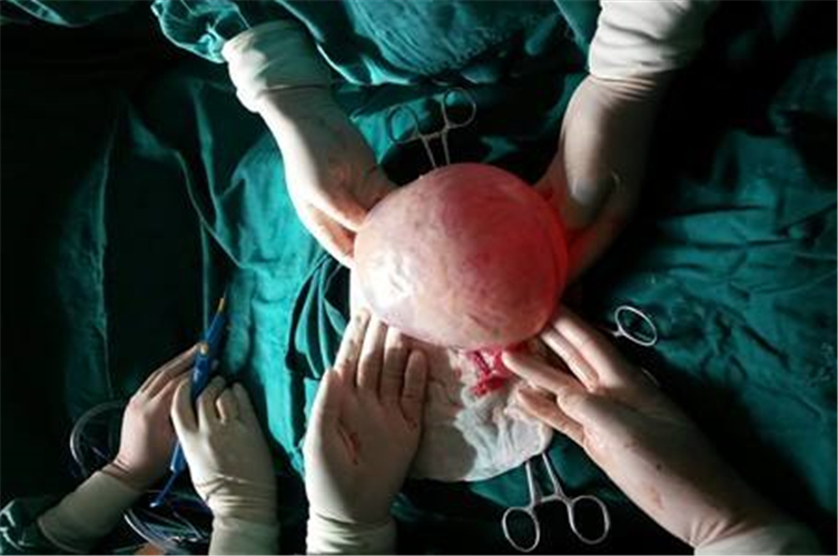 手術切除巨大卵巢囊腫