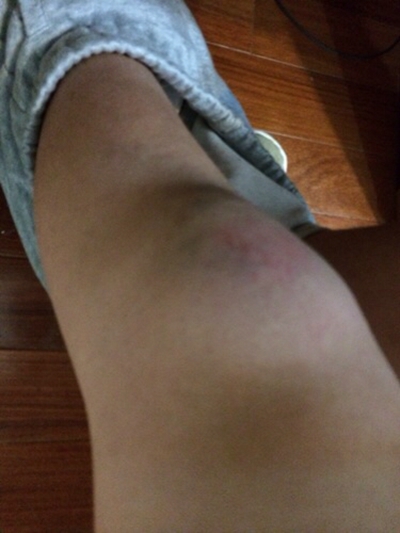 脛骨結節骨骺炎 (4) 