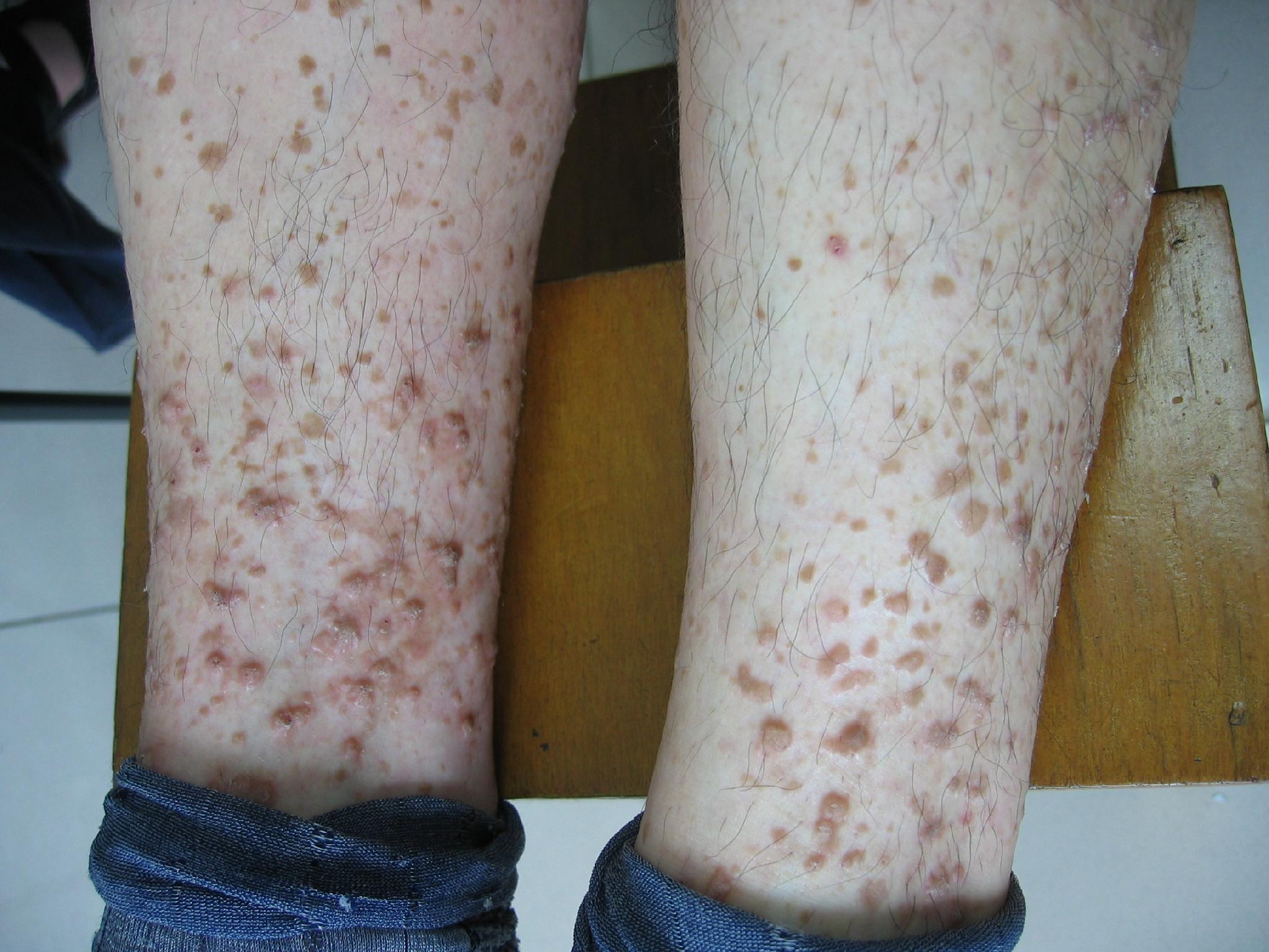 雙腿皮膚結核病的