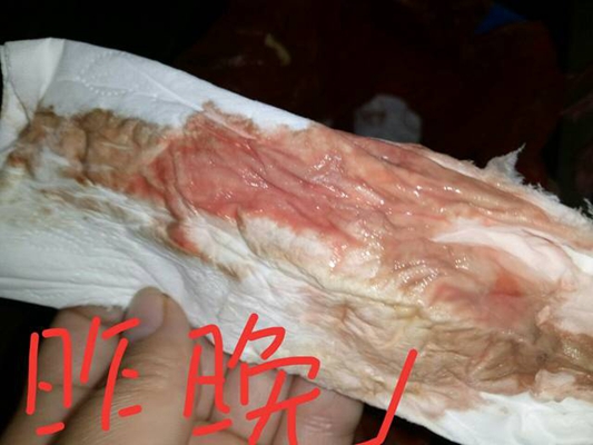 先兆流產分泌物