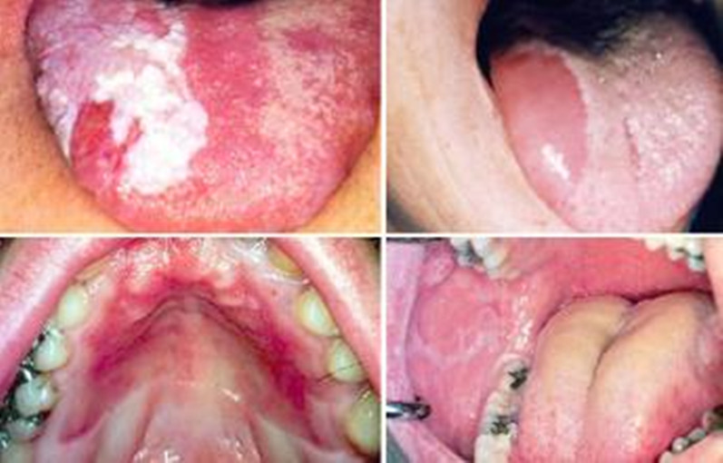 糖尿病口腔扁平苔蘚 