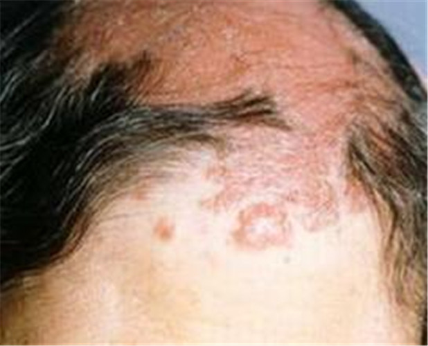 白塞病頭皮處