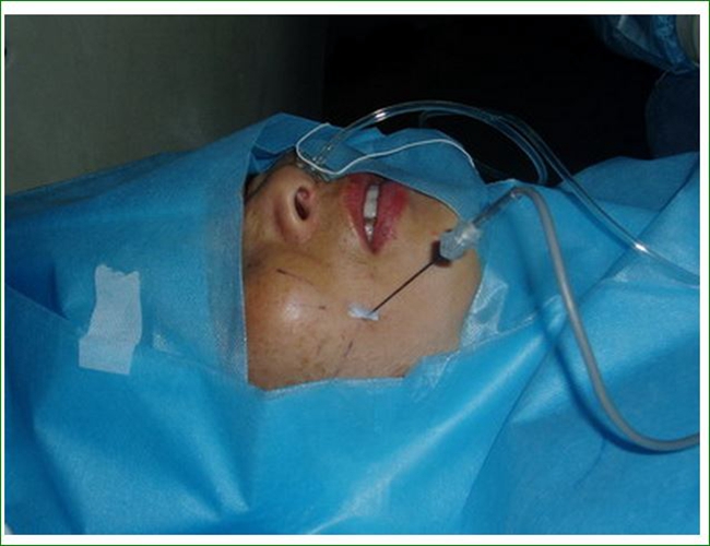 治療三叉神經痛