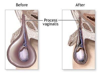 小兒鞘膜積液 (42) 