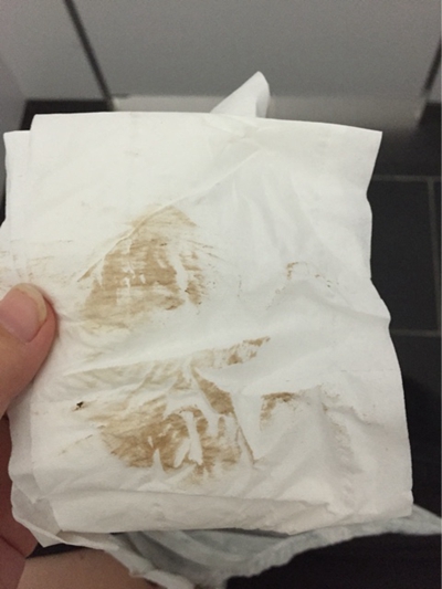 先兆流產分泌物