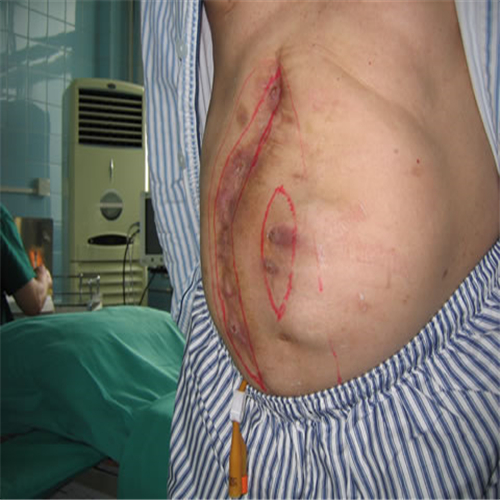 白線疝手術疤痕