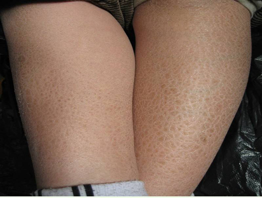 小腿皮膚像魚鱗 (6) 