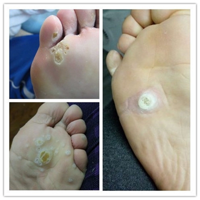 腳底蹠疣早期