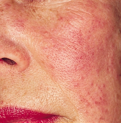 激素臉排毒症狀 (57) 