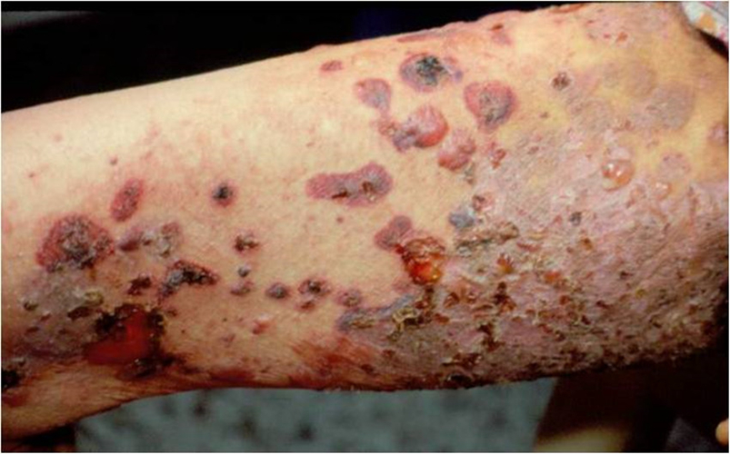 手臂大皰性皮膚病